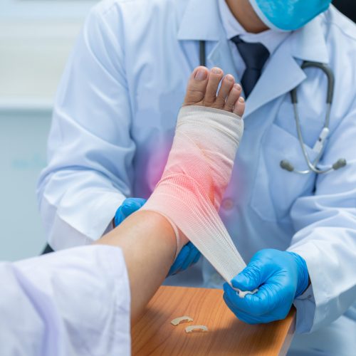 Close-up hand of orthopedic doctor wear medical gloves Of Doctor Hand Tying Bandage On The Leg Of Patient In Clinic, osteophytes and heel, inflammation Close-up hand of orthopedic doctor wear medical gloves Of Doctor Hand Tying Bandage On The Leg Of Patient In Clinic, osteophytes and heel, inflammation